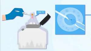 泰國(guó)試管胚胎移植方式有哪幾種